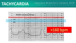 TACHYCARDIA
 