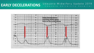 EARLY DECELERATIONS
 