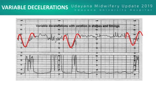 VARIABLE DECELERATIONS
 