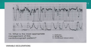 VARIABLE DECELERATIONS
 