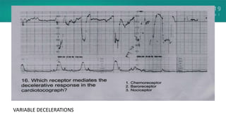VARIABLE DECELERATIONS
 
