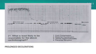 PROLONGED DECELERATIONS
 
