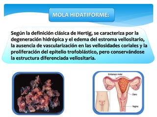 MOLA HIDATIFORME:
Según la definición clásica de Hertig, se caracteriza por la
degeneración hidrópica y el edema del estroma vellositario,
la ausencia de vascularización en las vellosidades coriales y la
proliferación del epitelio trofoblástico, pero conservándose
la estructura diferenciada vellositaria.
 