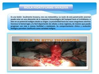 Es una lesión localmente invasora, rara vez metastática. La razón de esta penetración anormal
puede estar en una alteración de la respuesta inmunológica del huésped hacia el trofoblasto, o
bien en un potencial maligno desde su origen. La proximidad hacia los vasos sanguíneos uterinos
favorece la hemorragia y la fácil deportación de células a otras regiones, de manera que puede
progresar con más o menos facilidad a metástasis. Su comportamiento clínico y evolución
biológica permiten clasificarla como variedad maligna.
MOLA HIDATIFORME INVASIVA
 