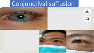 Conjunctival suffusion
 