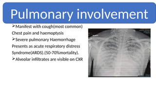 Manifest with cough(most common)
Chest pain and haemoptysis
Severe pulmonary Haemorrhage
Presents as acute respiratory distress
Syndrome(ARDS).(50-70%mortality).
Alveolar infiltrates are visible on CXR
Pulmonary involvement
 