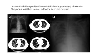 A computed tomography scan revealed bilateral pulmonary infiltrations.
The patient was then transferred to the intensive care unit.
 