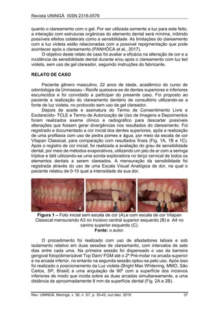 Revista UNINGÁ ISSN 2318-0579
Rev. UNINGÁ, Maringá, v. 56, n. S7, p. 35-42, out./dez. 2019 37
quanto o clareamento com o gel. Por ser utilizada somente a luz para este feito,
a interação com estruturas orgânicas do elemento dental será mínima, inibindo
possíveis efeitos colaterais como a sensibilidade. As limitações do clareamento
com a luz violeta estão relacionadas com a possível repigmentação que pode
acontecer após o clareamento (PANHÓCA et al., 2017).
O objetivo deste relato de caso foi avaliar a eficácia na alteração de cor e a
incidência de sensibilidade dental durante e/ou após o clareamento com luz led
violeta, sem uso de gel clareador, seguindo instruções do fabricante.
RELATO DE CASO
Paciente gênero masculino, 22 anos de idade, acadêmico do curso de
odontologia da Uninassau - Recife queixava-se de dentes superiores e inferiores
escurecidos e foi convidado a participar do presente caso. Foi proposto ao
paciente a realização do clareamento dentário de consultório utilizando-se a
fonte de luz violeta, no protocolo sem uso de gel clareador.
Depois de aceite e assinatura do Termo de Consentimento Livre e
Esclarecido- TCLE e Termo de Autorização de Uso de Imagens e Depoimentos
foram realizados exame clínico e radiográfico para descartar possíveis
alterações que fossem gerar divergências nos resultados do clareamento. Foi
registrado e documentado a cor inicial dos dentes superiores, após a realização
de uma profilaxia com uso de pedra pomes e água, por meio da escala de cor
Vitapan Classical, para comparação com resultados finais (Fig. 1A, 1B e 1C).
Após o registro de cor inicial, foi realizada a avaliação do grau de sensibilidade
dental, por meio de métodos evaporativos, utilizando um jato de ar com a seringa
tríplice e tátil utilizando-se uma sonda exploradora no terço cervical de todos os
elementos dentais a serem clareados. A mensuração da sensibilidade foi
registrada através do uso de uma Escala Visual Analógica de dor, na qual o
paciente relatou de 0-10 qual a intensidade da sua dor.
Figura 1 – Foto inicial sem escala de cor (A),e com escala de cor Vitapan
Classical mensurando A3 no Incisivo central superior esquerdo (B) e A4 no
canino superior esquerdo (C).
Fonte: o autor.
O procedimento foi realizado com uso de afastadores labiais e sob
isolamento relativo em duas sessões de clareamento, com intervalos de sete
dias entre cada uma. Na primeira sessão foi dispensado o uso da barreira
gengival fotopolimerizável Top Dam/ FGM até o 2º Pré-molar na arcada superior
e na arcada inferior, no entanto na segunda sessão optou-se pelo uso. Após isso
foi realizado o posicionamento da Luz violeta (Bright Max Whitening, MMO, São
Carlos, SP, Brasil) a uma angulação de 90º com a superfície dos incisivos
inferiores de modo que incida sobre as duas arcadas simultaneamente, a uma
distância de aproximadamente 8 mm da superfície dental (Fig. 2A e 2B).
 