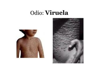 Odio: Viruela
 