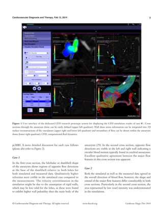 3Cardiovascular Diagnosis and Therapy, Feb 12, 2014
© Cardiovascular Diagnosis and Therapy. All rights reserved. Cardiovasc Diagn Ther 2014www.thecdt.org
pcMRI. A more detailed discussion for each case follows
(please also refer to Figure 2).
Case 1
In the first cross section, the bilobular or dumbbell shape
of the aneurysm shows regions of opposite flow directions
at the base of the dumbbell relative to both lobes for
both simulated and measured data. Qualitatively higher
velocities were visible in the simulated case compared to
the measurements. The velocity overestimation in the
simulation might be due to the assumption of rigid walls,
which may be less valid for the lobes, as these were found
to exhibit higher wall pulsatility then the main body of the
aneurysm (29). In the second cross section, opposite flow
directions are visible at the left and right wall indicating a
circular blood motion typically found in cerebral aneurysms.
Excellent qualitative agreement between the major flow
features in this cross section was apparent.
Case 2
Both the simulated as well as the measured data agreed in
the overall direction of blood flow, however, the shape and
extend of the major flow features differ considerably in both
cross sections. Particularly in the second cross section, the
area represented by low voxel intensity was underestimated
in the simulations.
Figure 1 User interface of the dedicated CFD research prototype system for displaying the CFD simulation results of case #1. Cross
sections through the aneurysm dome can be easily defined (upper left quadrant). Wall shear stress information can be integrated into 3D
surface reconstructions of the vasculature (upper right and lower left quadrant) and streamlines of flow can be shown within the aneurysm
dome (lower right quadrant). CFD, computational fluid dynamics.
 