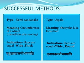 SUCCESSFUL METHODS
 Type- Nemi-sandanaka
 Meaning-Circumference
of a wheel
(round/circular sewing)
 Indication- Flaps are
equal -Wide ,Thick
पृथुलायतसमोभयपालल
 Type- Utpala
 Meaning-bhedyaka Like
lotus bud
 Indication- Flaps are
equal -Wide , Round
 वृत्तायतसमोभयपालल
 
