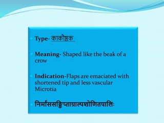  Type- काकौष्ठक
 Meaning- Shaped like the beak of a
crow
 Indication-Flaps are emaciated with
shortened tip and less vascular
Microtia
 लनमाांससलिप्ताग्राल्पशोलणतपाललाः
 
