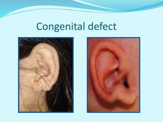 Congenital defect
 