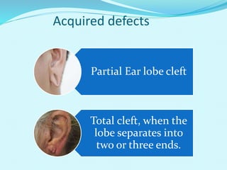 Acquired defects
Partial Ear lobe cleft
Total cleft, when the
lobe separates into
two or three ends.
 