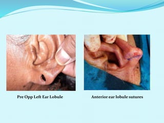 Anterior ear lobule sutures
Pre Opp Left Ear Lobule
 