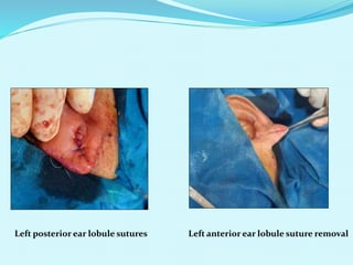 Left anterior ear lobule suture removal
Left posterior ear lobule sutures
 