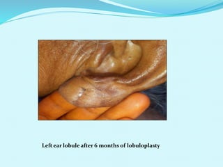 Left ear lobule after 6 months of lobuloplasty
 