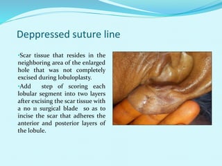 Deppressed suture line
•Scar tissue that resides in the
neighboring area of the enlarged
hole that was not completely
excised during lobuloplasty.
•Add step of scoring each
lobular segment into two layers
after excising the scar tissue with
a no 11 surgical blade so as to
incise the scar that adheres the
anterior and posterior layers of
the lobule.
 