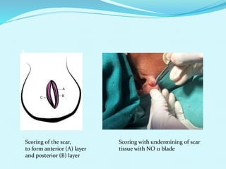 Scoring of the scar,
to form anterior (A) layer
and posterior (B) layer
Scoring with undermining of scar
tissue with NO 11 blade
 