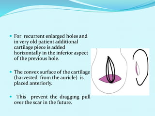  For recurrent enlarged holes and
in very old patient additional
cartilage piece is added
horizontally in the inferior aspect
of the previous hole.
 The convex surface of the cartilage
(harvested from the auricle) is
placed anteriorly.
 This prevent the dragging pull
over the scar in the future.
 