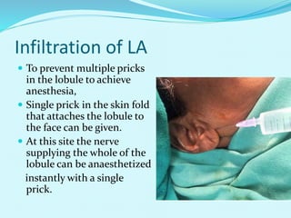 Infiltration of LA
 To prevent multiple pricks
in the lobule to achieve
anesthesia,
 Single prick in the skin fold
that attaches the lobule to
the face can be given.
 At this site the nerve
supplying the whole of the
lobule can be anaesthetized
instantly with a single
prick.
 