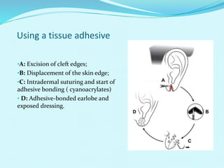 Using a tissue adhesive
•A: Excision of cleft edges;
•B: Displacement of the skin edge;
•C: Intradermal suturing and start of
adhesive bonding ( cyanoacrylates)
• D: Adhesive-bonded earlobe and
exposed dressing.
 