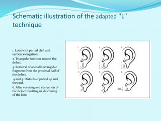 Schematic illustration of the adapted "L"
technique
1. Lobe with partial cleft and
vertical elongation.
2. Triangular incision around the
defect.
3. Removal of a small rectangular
fragment from the proximal half of
the defect.
4 and 5. Distal half pulled up and
forward.
6. After suturing and correction of
the defect resulting in shortening
of the lobe
 