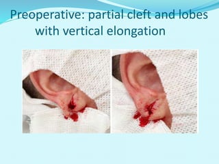 Preoperative: partial cleft and lobes
with vertical elongation
 