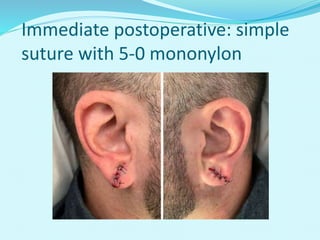 Immediate postoperative: simple
suture with 5-0 mononylon
 