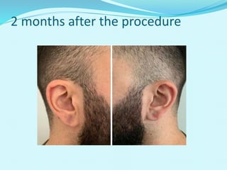 2 months after the procedure
 