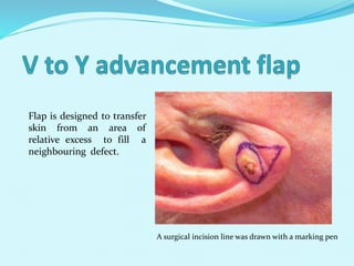 A surgical incision line was drawn with a marking pen
Flap is designed to transfer
skin from an area of
relative excess to fill a
neighbouring defect.
 