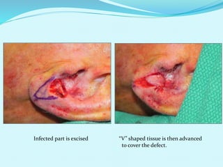 “V” shaped tissue is then advanced
to cover the defect.
Infected part is excised
 