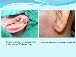 Donor site is sutured in a straight line
which creates a “Y” shaped closure.
Postoperative result at 6 month follow-up
 