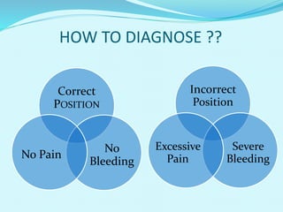 HOW TO DIAGNOSE ??
Incorrect
Position
Severe
Bleeding
Excessive
Pain
Correct
POSITION
No
Bleeding
No Pain
 