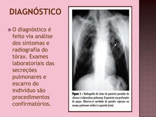  O diagnóstico é
feito via análise
dos sintomas e
radiografia do
tórax. Exames
laboratoriais das
secreções
pulmonares e
escarro do
indivíduo são
procedimentos
confirmatórios.
 