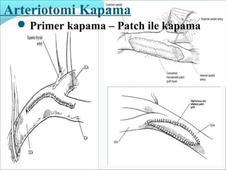 Arteriotomi Kapama
Primer kapama – Patch ile kapama
 