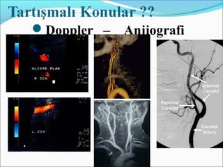 Doppler – Anjiografi
 
