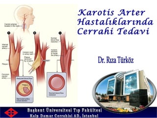 Karotis Arter
Hastalıklarında
Cerrahi Tedavi
 