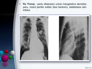 • Ro Thorax : perlu dilakukan untuk mengetahui densitas
paru, nodul perifer soliter (lesi berkoin), atelektasis dan
infeksi
 