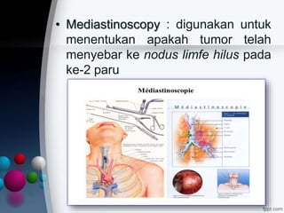 • Mediastinoscopy : digunakan untuk
menentukan apakah tumor telah
menyebar ke nodus limfe hilus pada
ke-2 paru
 