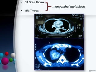• CT Scan Thorax
mengetahui metastase
• MRI Thorax
 