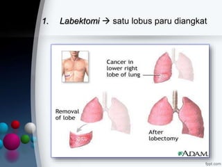 1. Labektomi  satu lobus paru diangkat
 