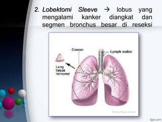 2. Lobektomi Sleeve  lobus yang
mengalami kanker diangkat dan
segmen bronchus besar di reseksi
 