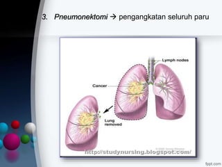 3. Pneumonektomi  pengangkatan seluruh paru
 
