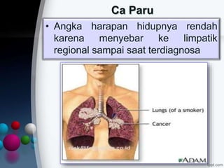 Ca Paru
• Angka harapan hidupnya rendah
karena menyebar ke limpatik
regional sampai saat terdiagnosa
 