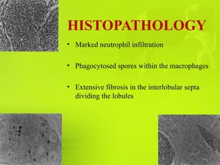 HISTOPATHOLOGY
• Marked neutrophil infiltration
• Phagocytosed spores within the macrophages
• Extensive fibrosis in the interlobular septa
dividing the lobules
 