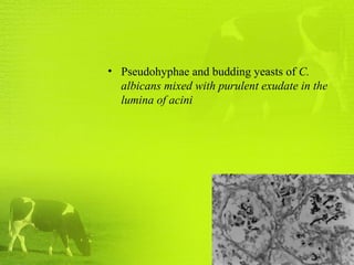 • Pseudohyphae and budding yeasts of C.
albicans mixed with purulent exudate in the
lumina of acini
 