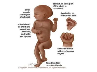 Karyotypes and dysmorphic features | PPTX