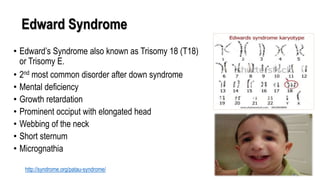 Edward Syndrome
• Edward’s Syndrome also known as Trisomy 18 (T18)
or Trisomy E.
• 2nd most common disorder after down syndrome
• Mental deficiency
• Growth retardation
• Prominent occiput with elongated head
• Webbing of the neck
• Short sternum
• Micrognathia
http://syndrome.org/patau-syndrome/
 