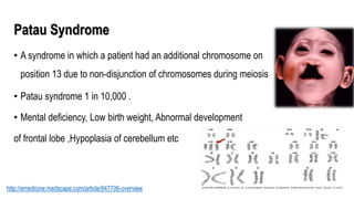 Patau Syndrome
• A syndrome in which a patient had an additional chromosome on
position 13 due to non-disjunction of chromosomes during meiosis
• Patau syndrome 1 in 10,000 .
• Mental deficiency, Low birth weight, Abnormal development
of frontal lobe ,Hypoplasia of cerebellum etc
http://emedicine.medscape.com/article/947706-overview
 